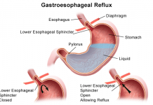 关于新生儿Reflux(胃食管返流) Reflux的症状