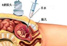 在美国做羊水穿刺(amniocentesis)相关知识 美国羊水穿刺