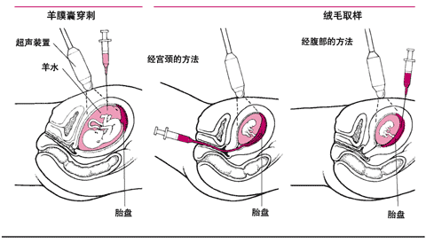 绒毛膜采样CVS和羊水穿刺
