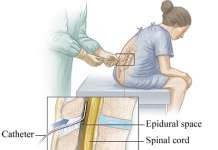 妈妈分享 – 催产无痛分娩(Epidural)顺产产经 在美国生孩子