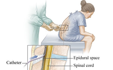 无痛分娩epidural