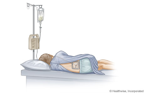 无痛分娩epidural