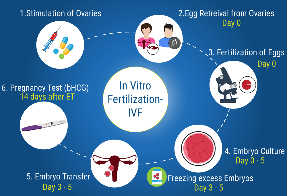 IVF试管婴儿