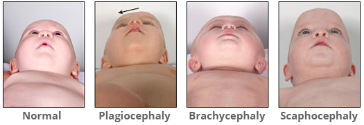 Factores que afectan la forma de la cabeza del bebé.