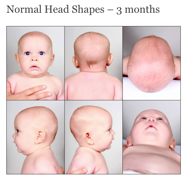 Factors affecting baby's head shape