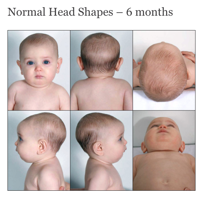 Factors affecting baby's head shape