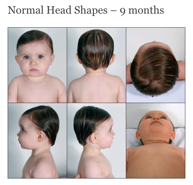 Factors affecting baby's head shape