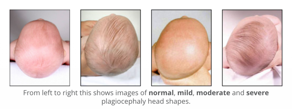 Factores que afectan la forma de la cabeza del bebé.