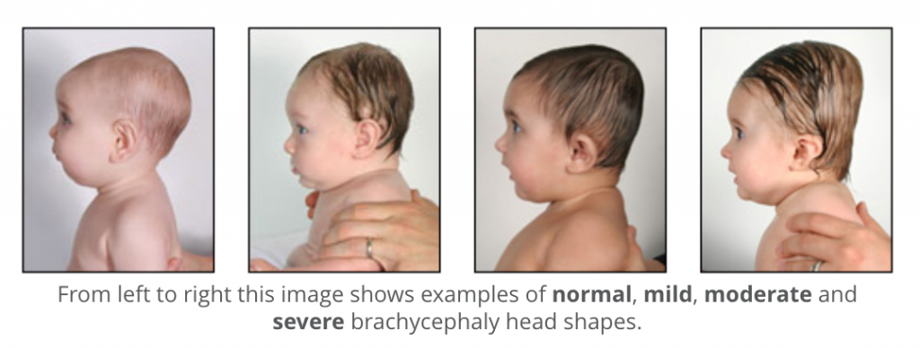 Factors affecting baby's head shape