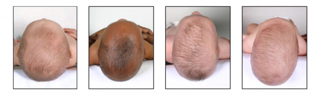 Factors affecting baby's head shape
