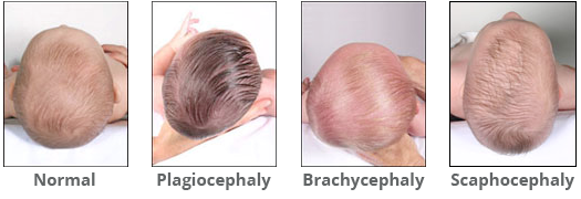 Factores que afectan la forma de la cabeza del bebé.