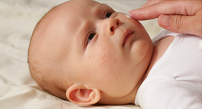 宝宝湿疹与辅食过敏关系