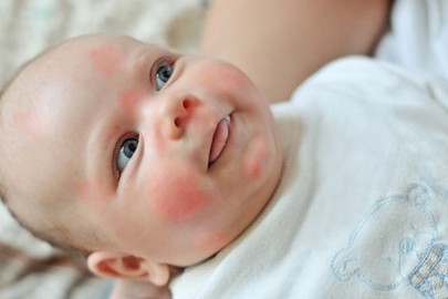 宝宝湿疹与辅食过敏关系
