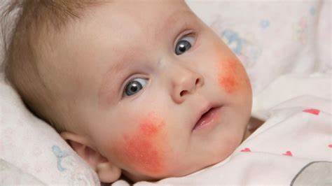 宝宝湿疹的症状