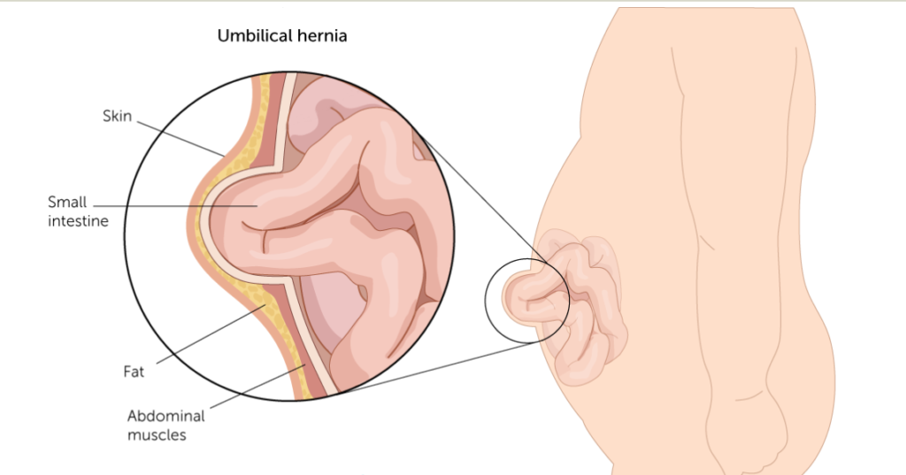 美国宝宝脐疝umbilical hernia