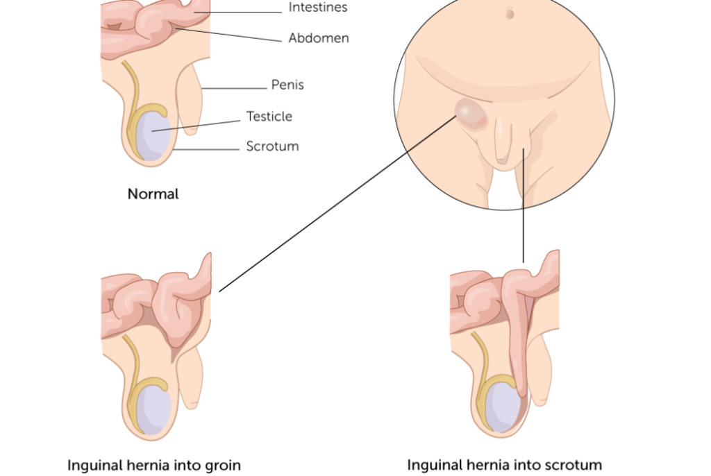 美国宝宝脐疝umbilical hernia