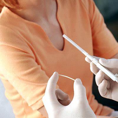 美国皮下埋植避孕法