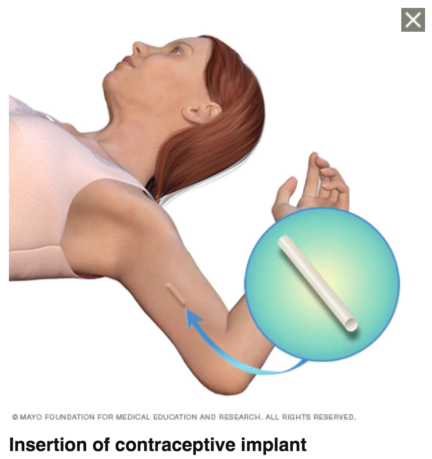 美国皮下埋植避孕法