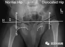 宝宝髋关节发育不良 宝宝髋关节发育不良