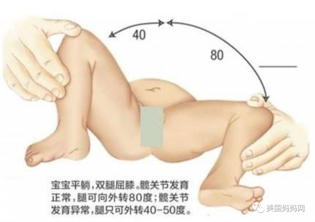 宝宝髋关节发育不良 宝宝髋关节发育不良