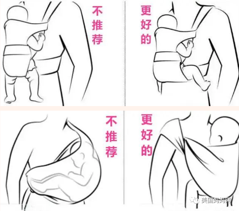宝宝髋关节发育不良 宝宝髋关节发育不良