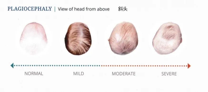 美国宝宝矫正头盔