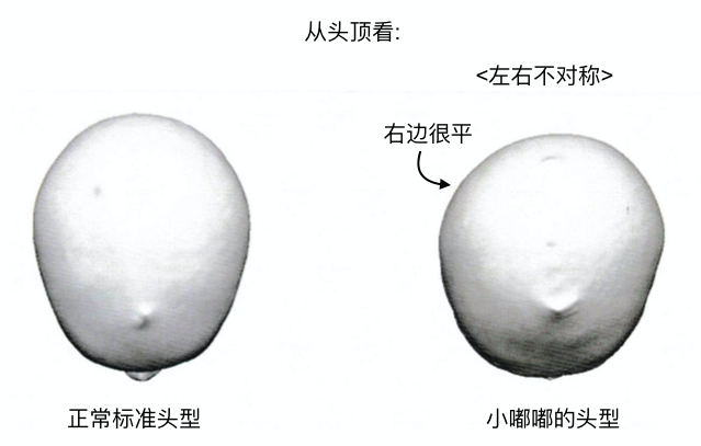 美国宝宝头型矫正 美国宝宝头型矫正