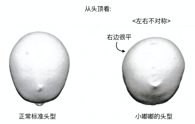 美国宝宝头型矫正