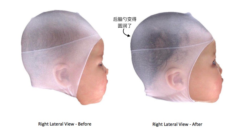 美国宝宝头型矫正