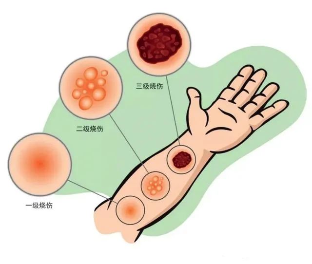 孩子烧烫伤,冷静!最佳处理时间只有2分钟 孩子烧烫伤怎么办?什么时候去看医生?