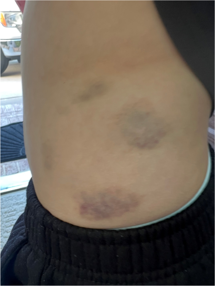【妈妈分享】孩子在美国daycare被老师abuse,我是这样做的 【妈妈分享】孩子在美国daycare被老师abuse,我是这样做的