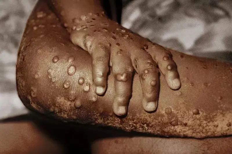 美国首例猴痘死亡，全美至少已报告31例儿童猴痘感染！