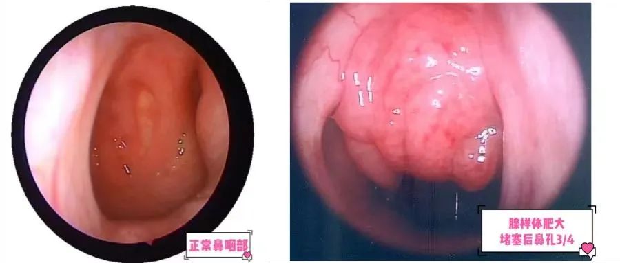 孩子睡觉时打呼噜?经常出现鼻窦炎?口齿不清?或许你该check一下孩子的腺样体! 孩子睡觉时打呼噜?经常出现鼻窦炎?口齿不清?或许你该check一下孩子的腺样体!