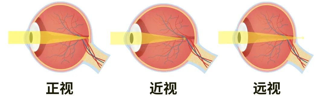 你还在疑惑远视储备是什么吗?快来快来,儿童视力小课堂开课啦! 你还在疑惑远视储备是什么吗?快来快来,儿童视力小课堂开课啦!