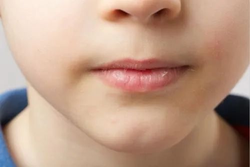 秋天到了,孩子嘴唇反复开裂、脱屑、出血,到底是怎么了? 秋天到了,孩子嘴唇反复开裂、脱屑、出血,到底是怎么了?