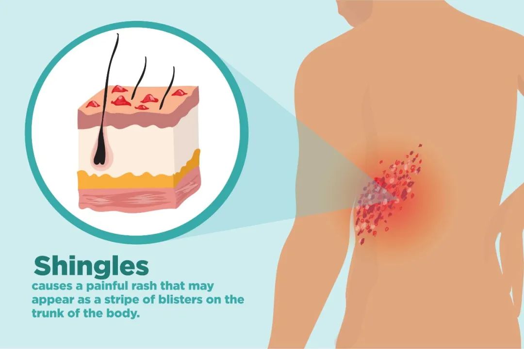 发烧、咳嗽、头疼、想吐，你以为得了COVID、Flu、RSV？NO！这是带状疱疹在作怪！