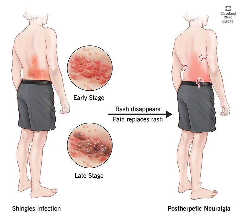 发烧、咳嗽、头疼、想吐，你以为得了COVID、Flu、RSV？NO！这是带状疱疹在作怪！