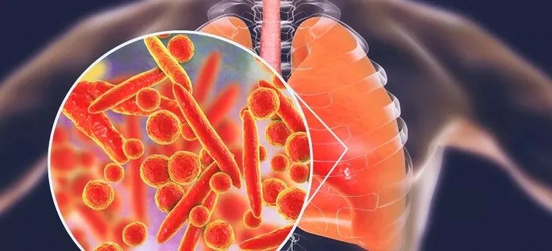 俄亥俄州“白肺”肺炎病例正在激增！与支原体有关吗？