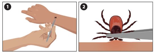 讨厌的Tick蜱虫活跃季来了，真是防不胜防！如何保护自己免受Lyme莱姆病的侵扰？
